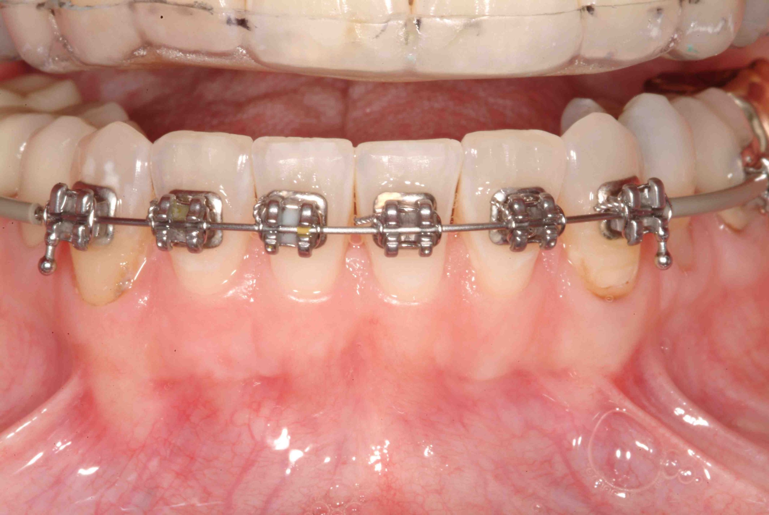 Retention & Orthodontic Treatment