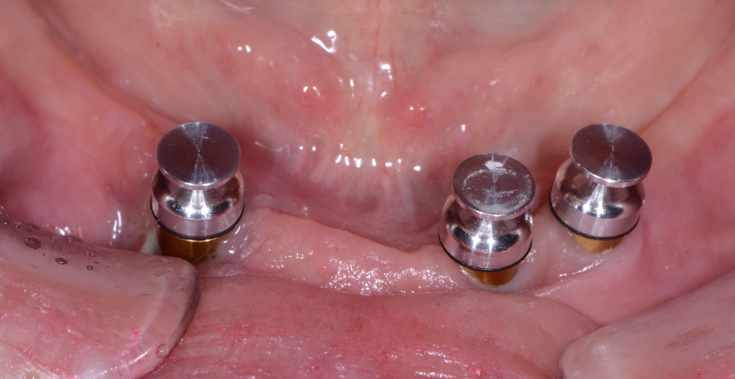Treatment Planning For Future Implant Cases