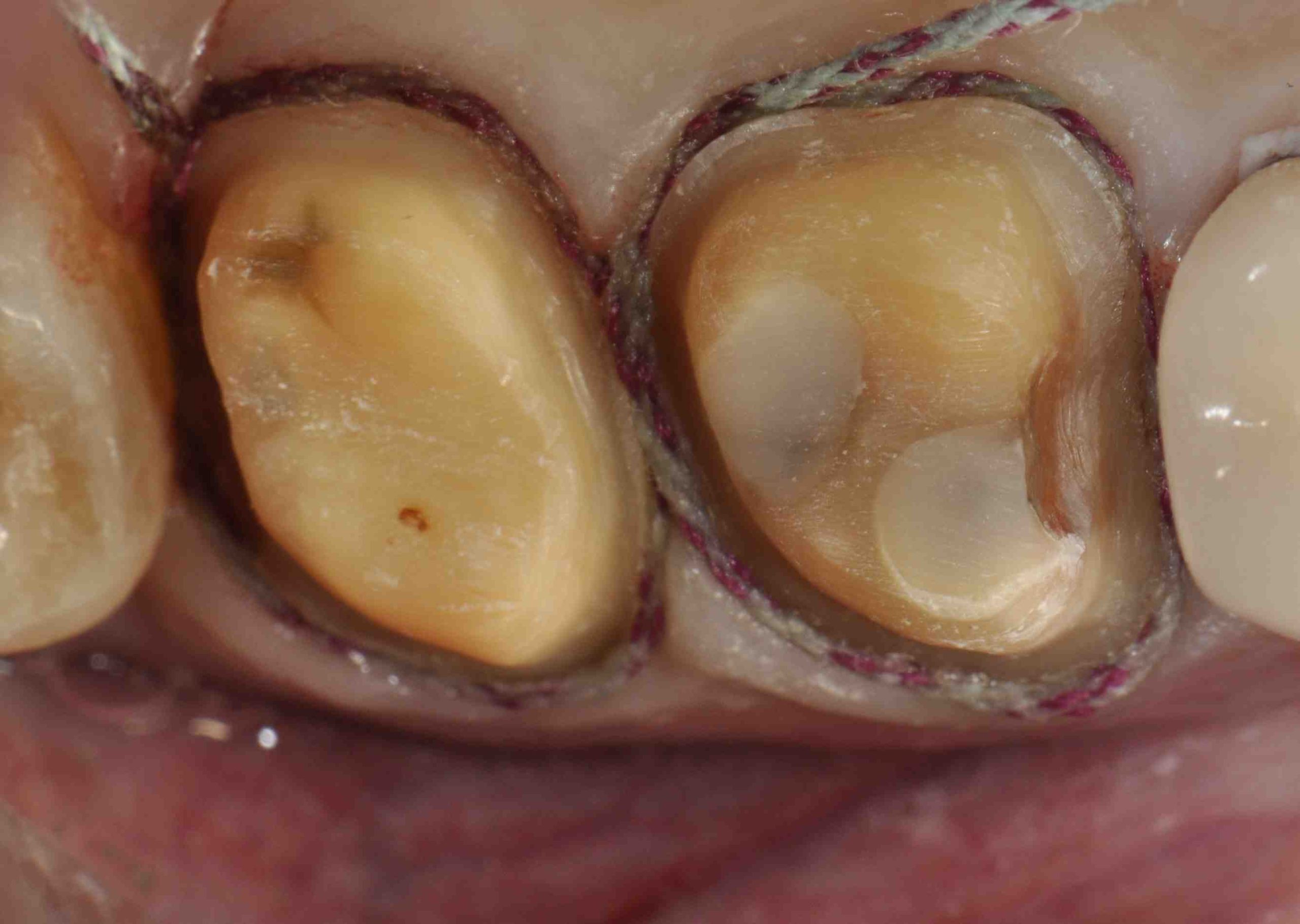 Restorative Tips: Successful Intracrevicular Tooth Preparation