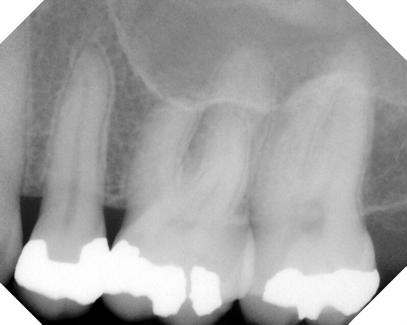 Occlusion Makes a Difference for Patients With Periodontitis