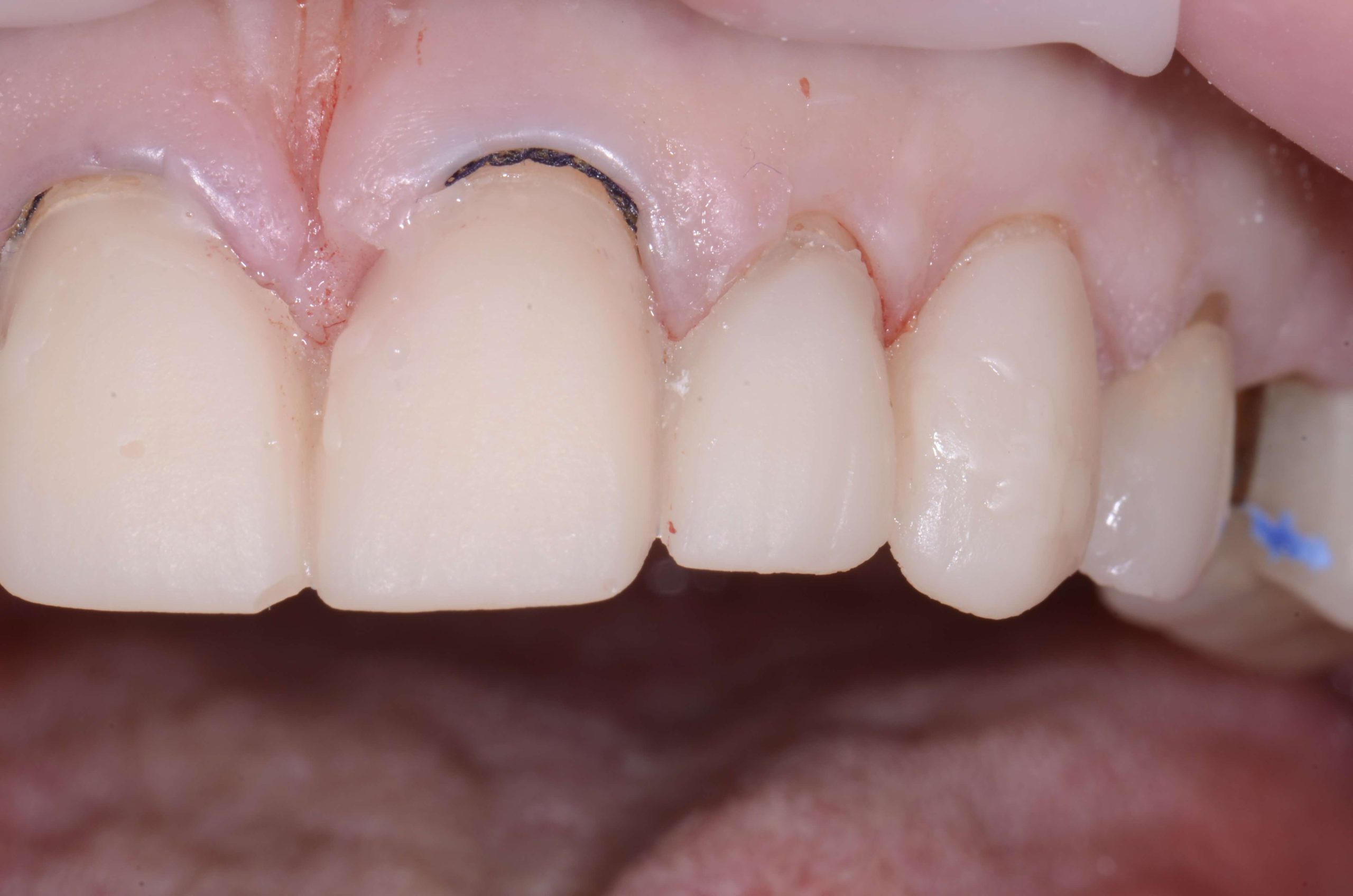 Shrink Wrap Provisional Technique for Predictable Veneers: Part 3