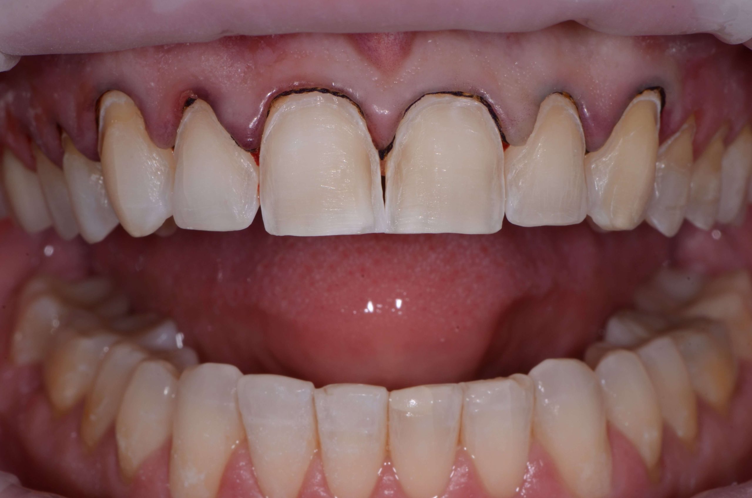 Shrink Wrap Provisional Technique for Predictable Veneers: Part 2