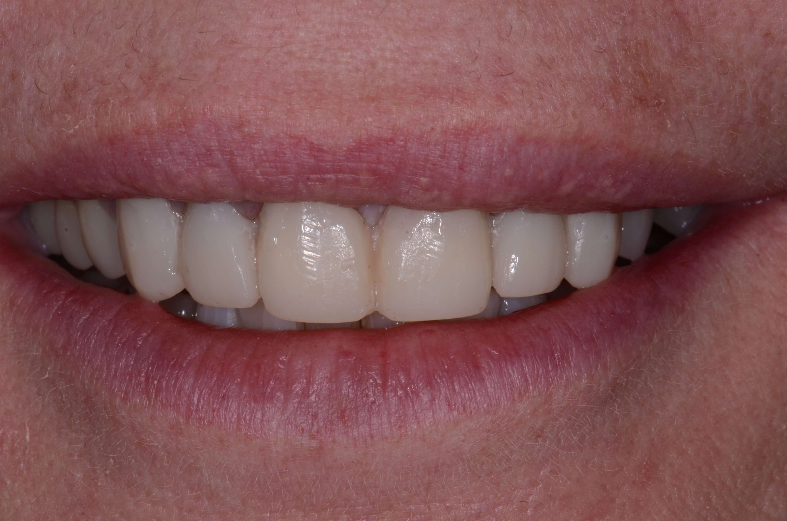 Shrink Wrap Provisional Technique for Predictable Veneers: Part 4