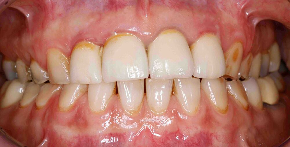 Occlusal Wear Part 2: What is causing the wear?