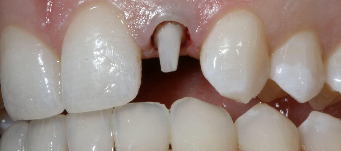 Understanding Tooth Ferrule