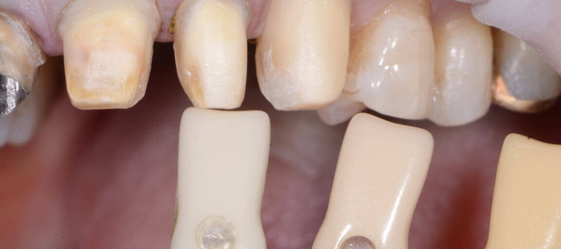 Why Do Prepared Teeth Discolor?
