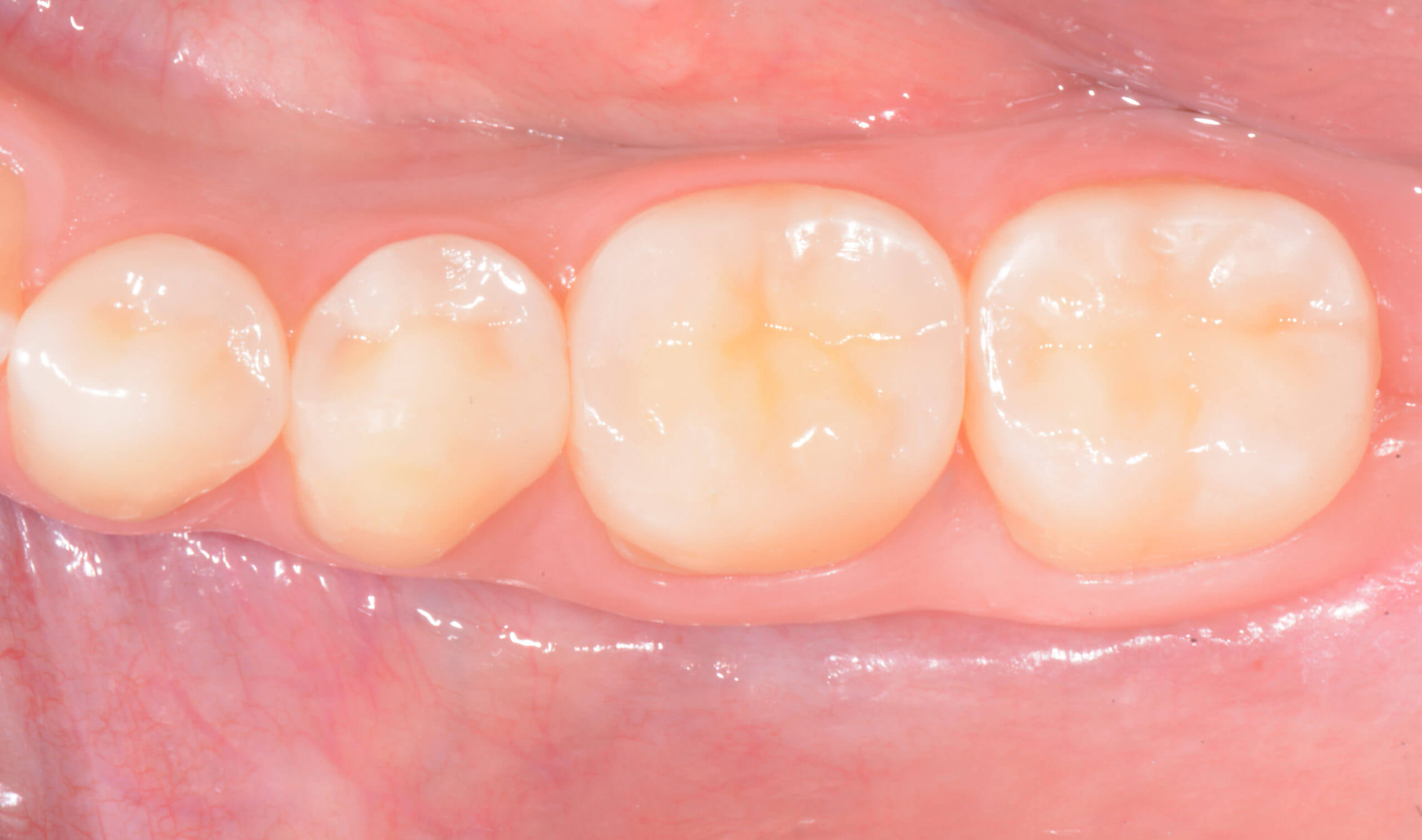 Adhesive Management of Worn Dentition Using the “Index Technique” The DIRECT Approach