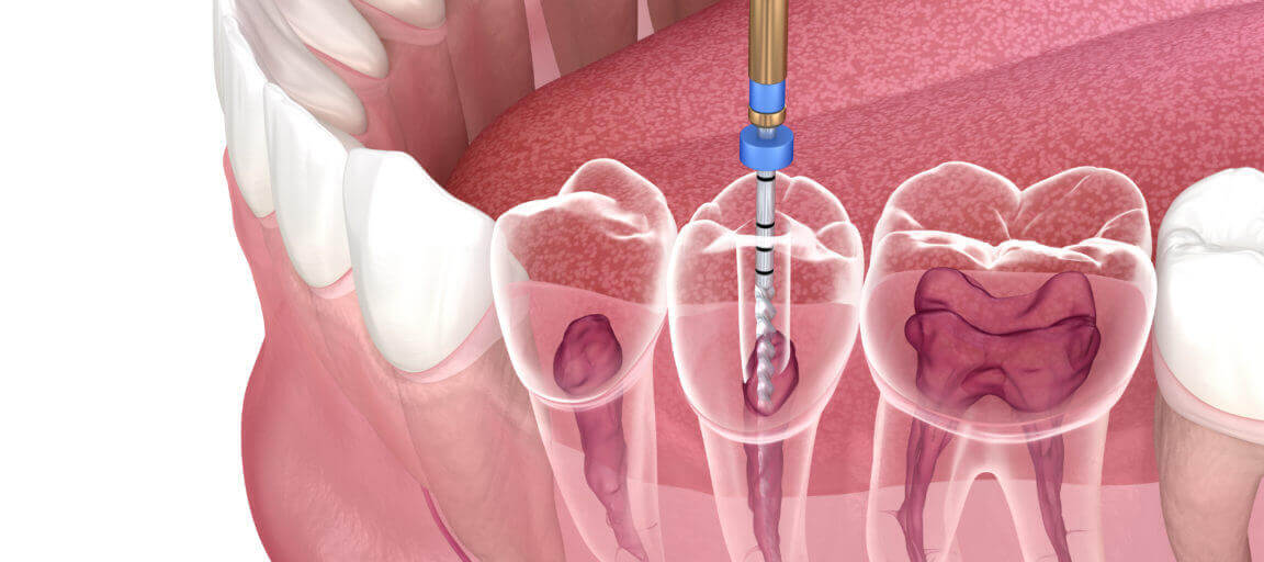 Making Endodontic Diagnosis More Accurate 