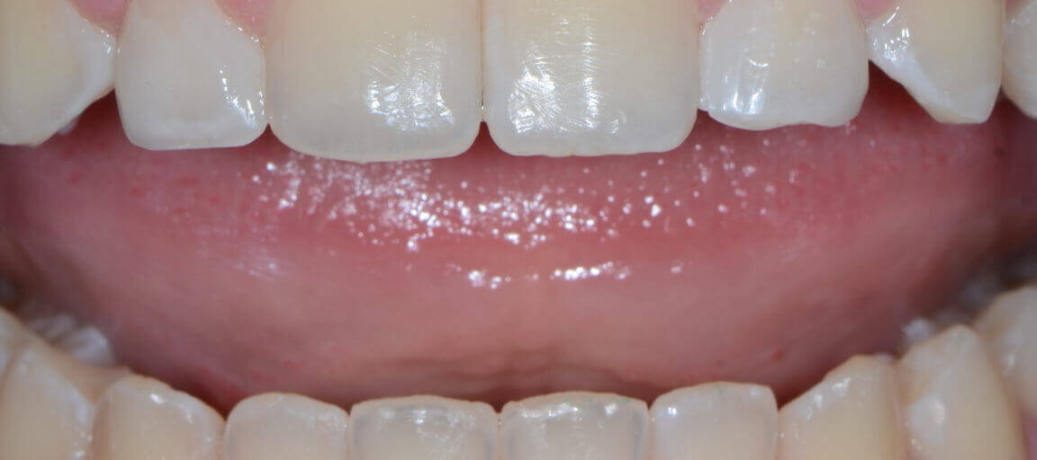 Positioning Peg Laterals & Undersized Lateral Incisors for Optimal Aesthetics 