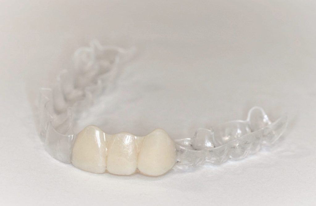 Dental Care While Wearing an Essix Retainer 